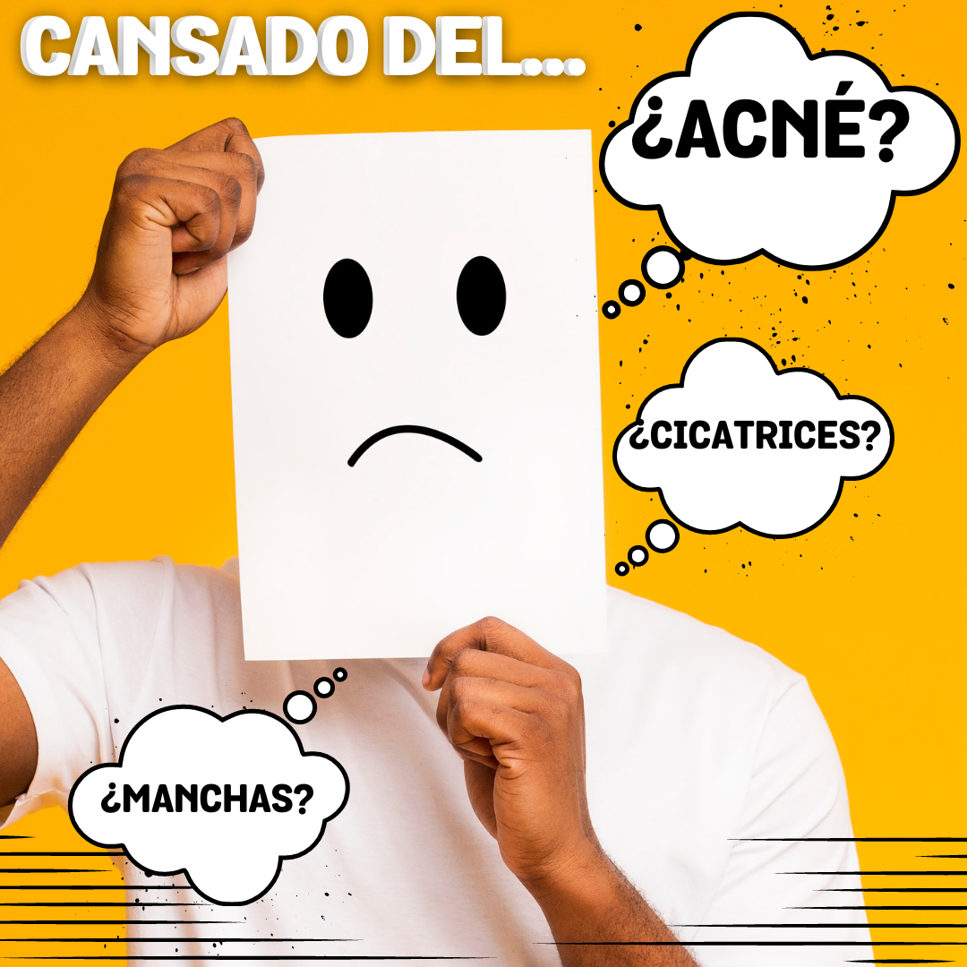 Los mejores consejos para prevenir el acné